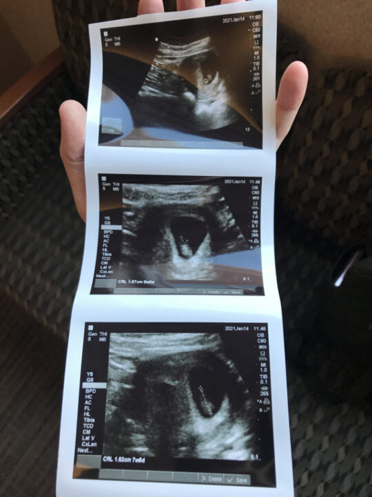 Ultrasound of Olivia